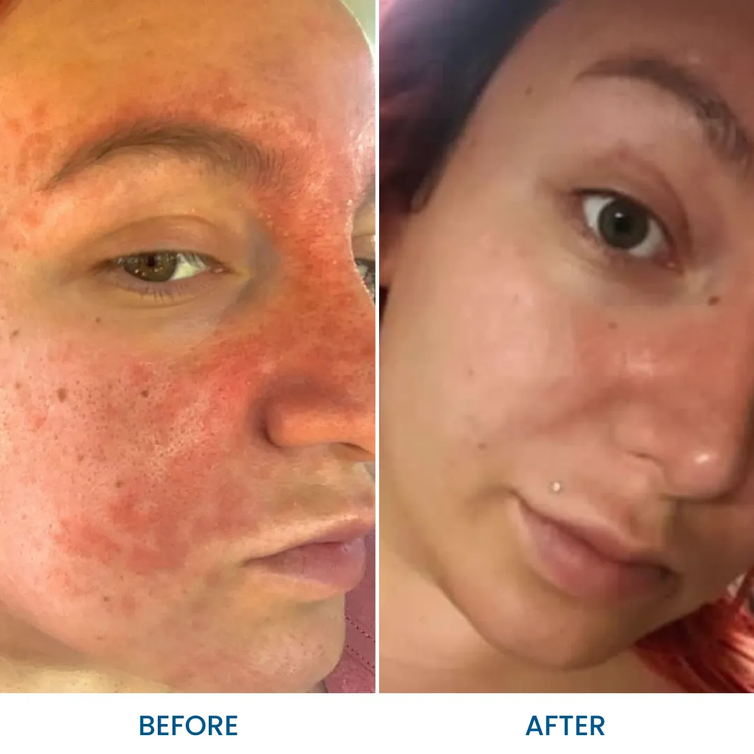 Face Psoriasis Pack