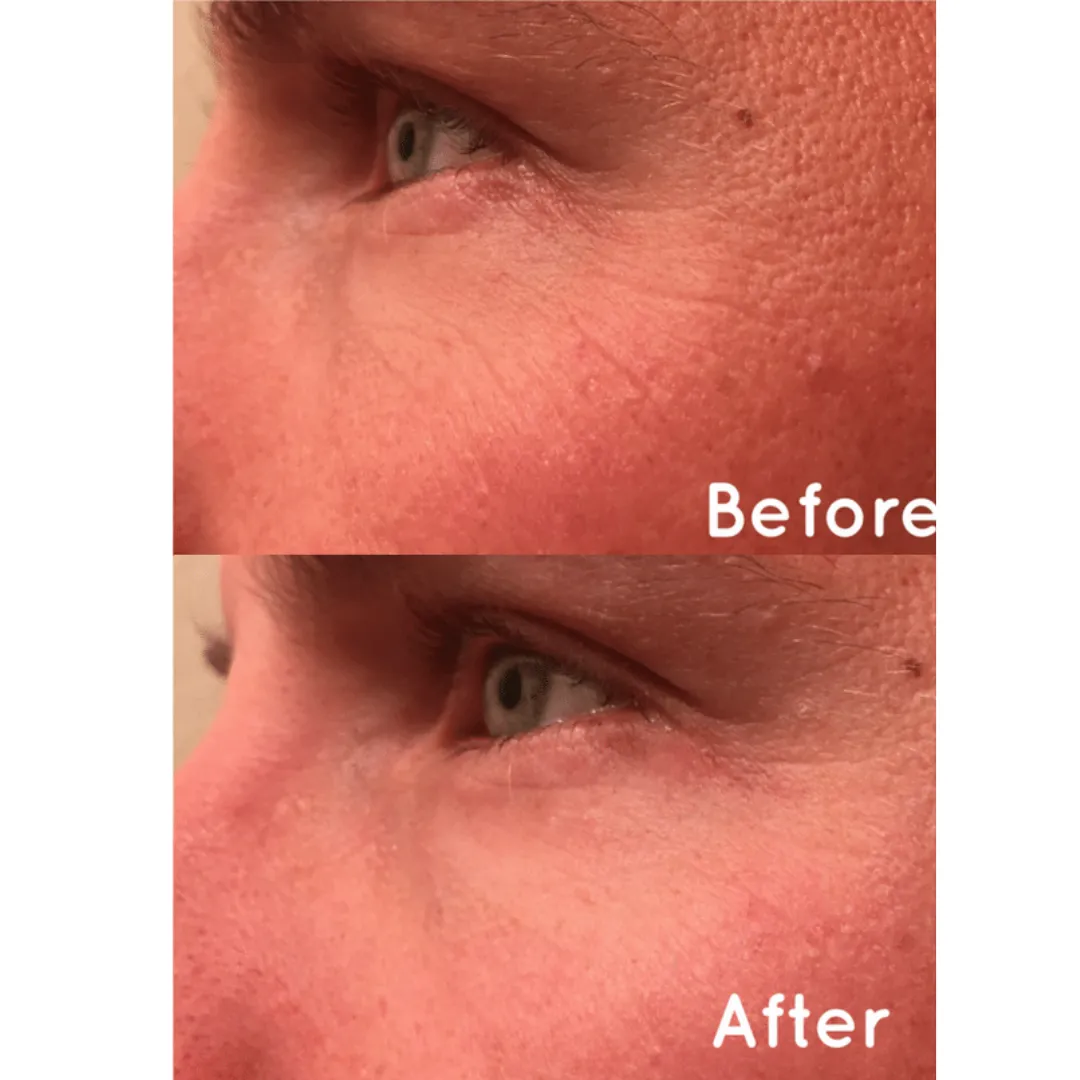 MBK Eye Rejuvenator - Your Ultimate Solution for Ageless Eyes!
