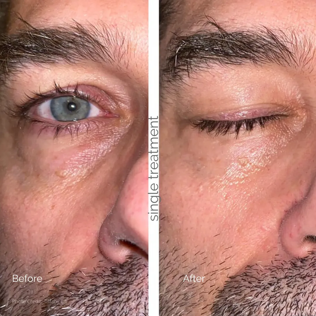 MBK Eye Rejuvenator - Your Ultimate Solution for Ageless Eyes!
